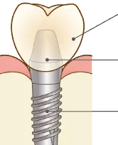 インプラント治療の術式